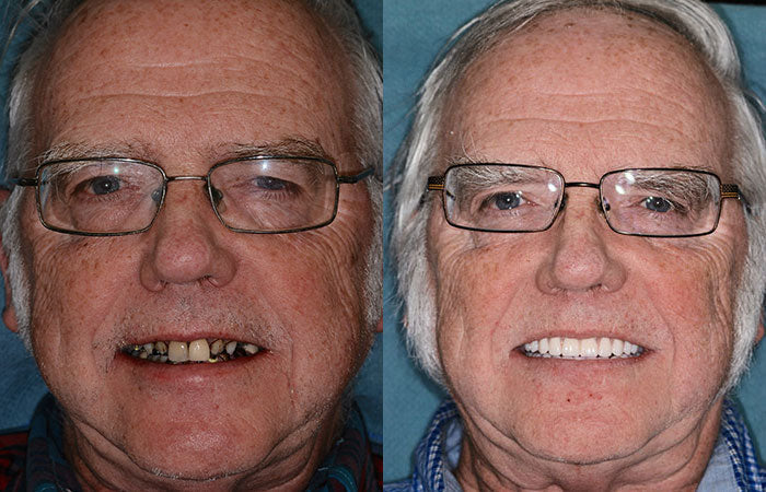 Koadclo | HZA™-Advanced Customized Full Denture Set
