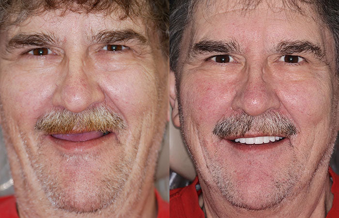 Koadclo | HZA™-Advanced Customized Full Denture Set