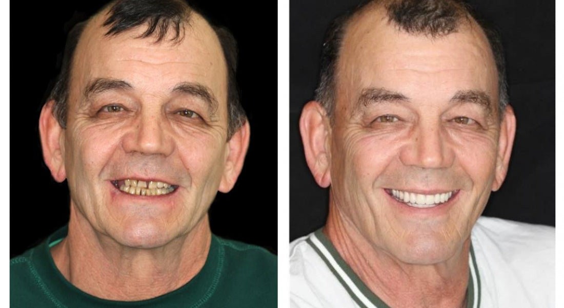 Koadclo | HZA™-Advanced Customized Full Denture Set