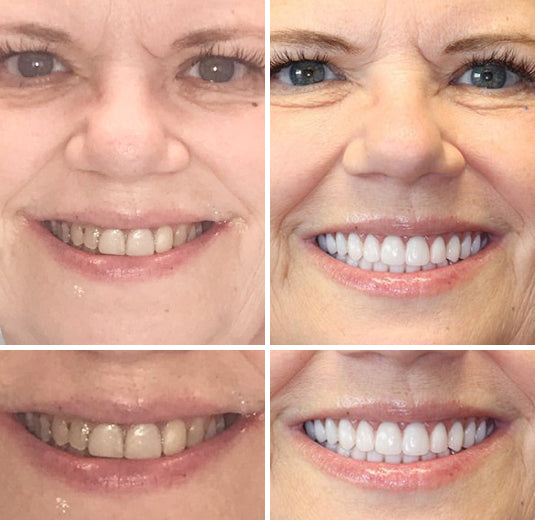 Koadclo | HZA™-Advanced Customized Full Denture Set