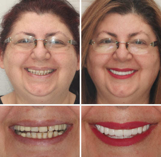 Koadclo | HZA™-Advanced Customized Full Denture Set