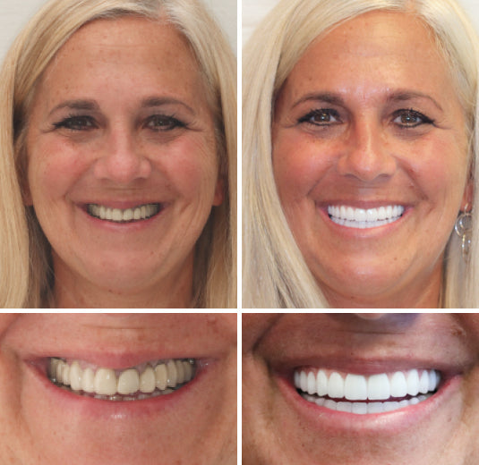 Koadclo | HZA™-Advanced Customized Full Denture Set